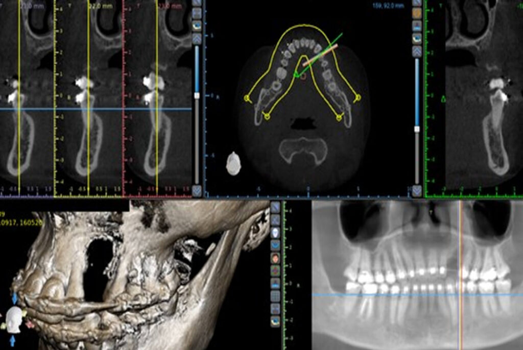 capa-case-maxillary