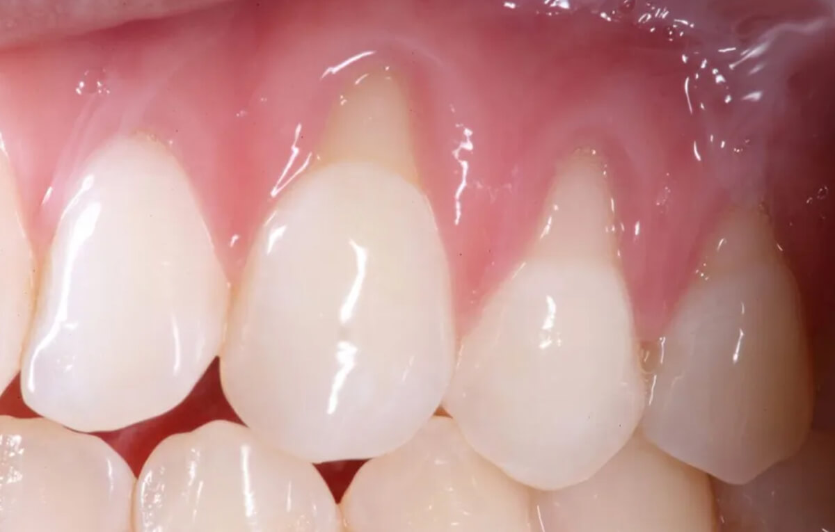 tratamento-soep-Cirurgia-Periodontal