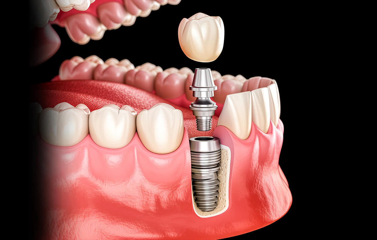 tratamento-soep-implante-dentário