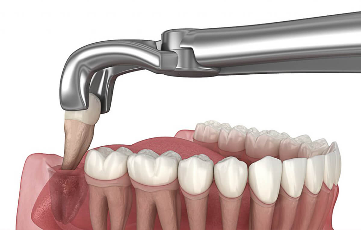 tratamento-soep-remoção-siso