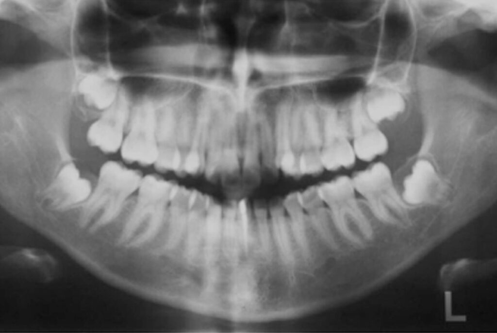 A-influência-da-geminação-dentária
