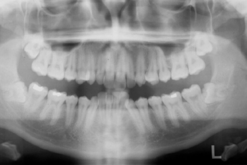 COLAGEM-DIFERENCIADA-DOS-ACESSÓRIOS-ORTODÔNTICOS